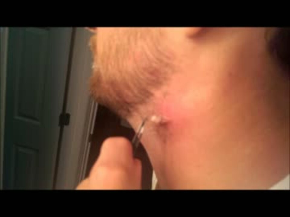 粉瘤 の袋取り ニコニコ動画