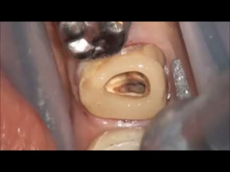歯医者さんで歯の根治療 - ニコニコ動画
