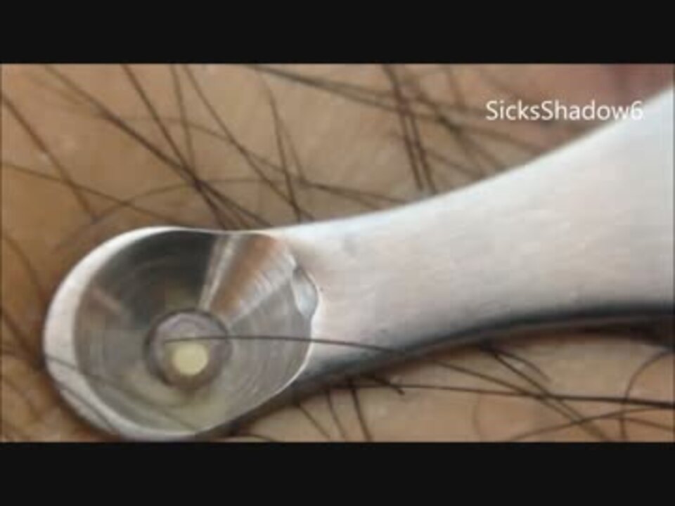 太もも毛嚢炎 圧出器でブチッ ニコニコ動画