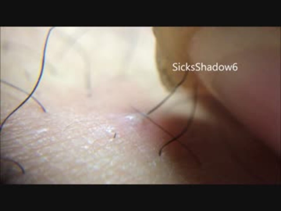 毛穴ニキビに埋まってる毛が予想以上に長くてワロタｗｗｗ ニコニコ動画