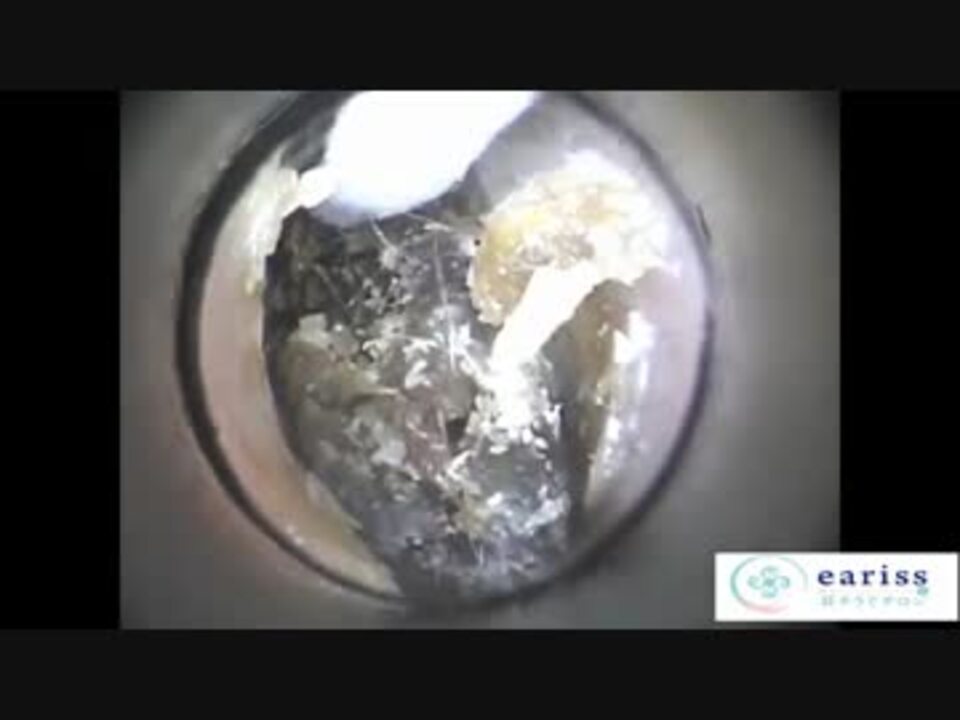 耳掃除 衝撃 固まった耳垢 ごっそり 両耳 閲覧注意 ニコニコ動画