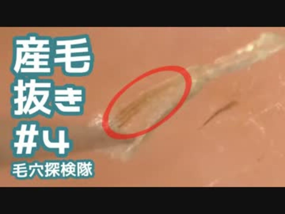 4 産毛抜き 産毛が３本入った角栓を発見 ニコニコ動画