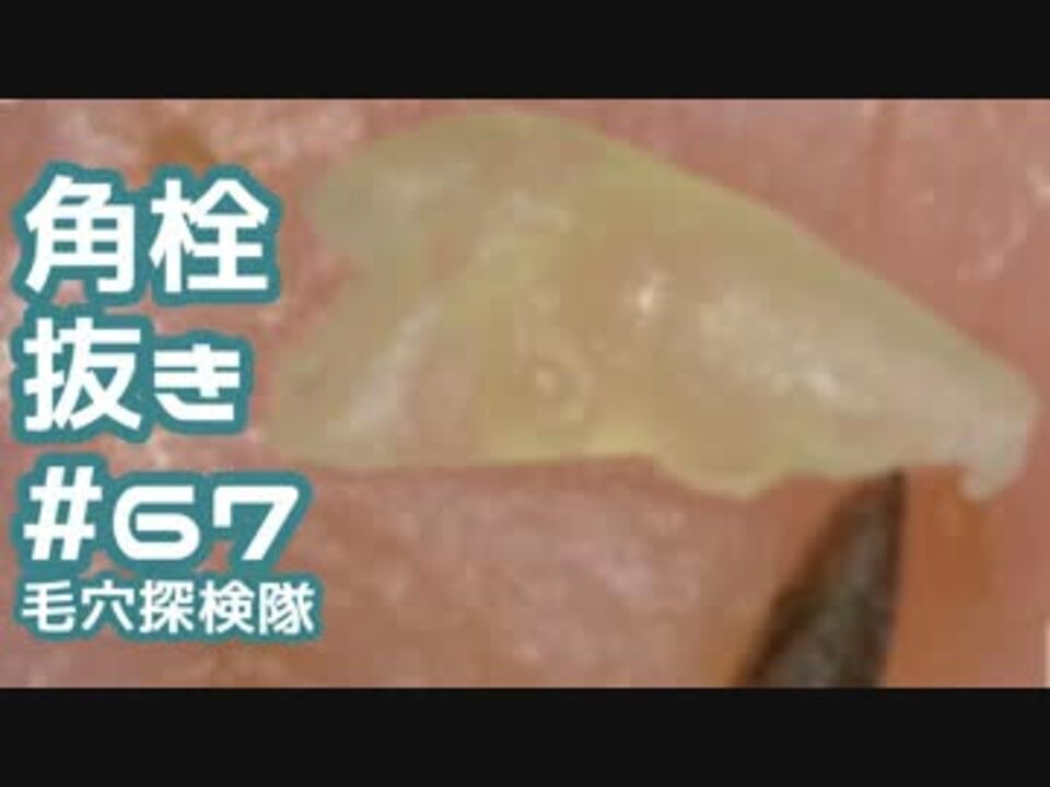 人気の 角栓 動画 178本 2 ニコニコ動画