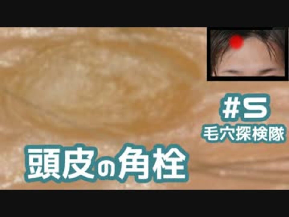 5 頭皮 生え際 にガッツリ埋まってた角栓を抜いてみた ニコニコ動画