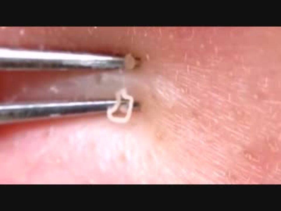 頬の角栓をニュルニュル取ってみる ニコニコ動画