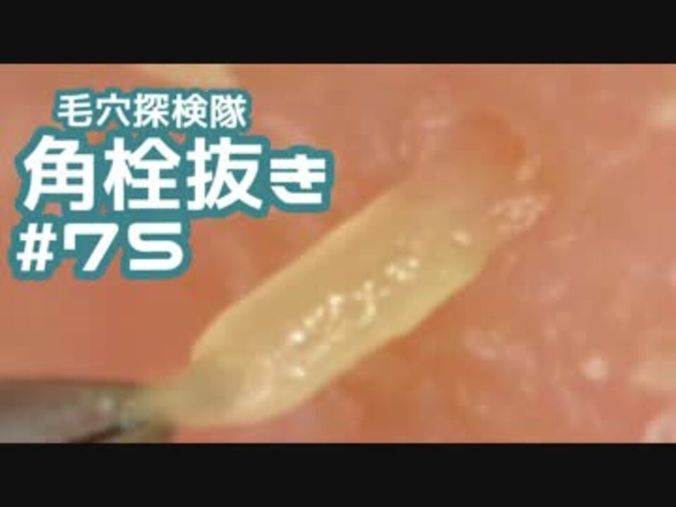 75 角栓を0倍で抜いてみた 大物がスーッと抜けてスッキリ ニコニコ動画