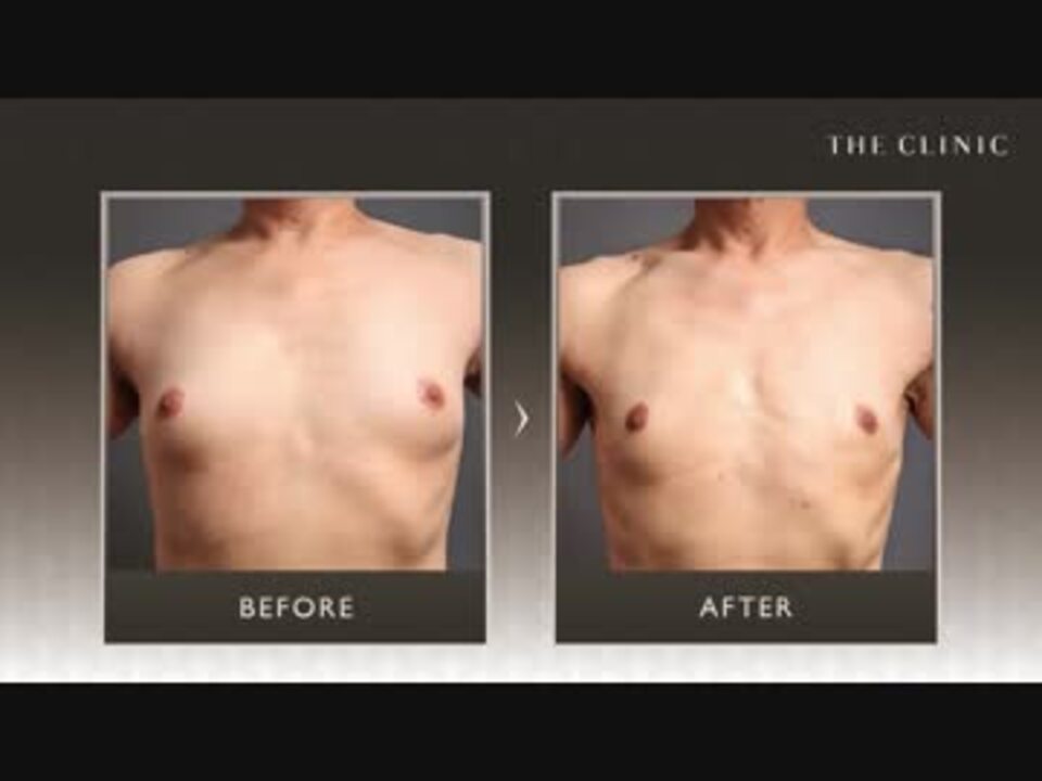 男性の胸が大きくなる女性化乳房症の手術 ニコニコ動画