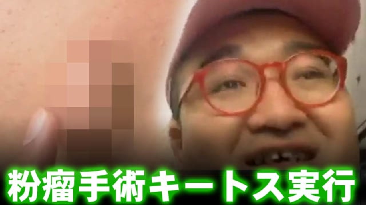 野田草履 粉瘤手術キートス実行 金バエは痔瘻 ニコニコ動画