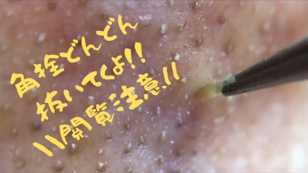 角栓マニア 鼻の角栓ピンセットで抜いちゃうよ 初めて抜いてみた編 Pimplepopping Blackheads Whiteheads ニコニコ動画