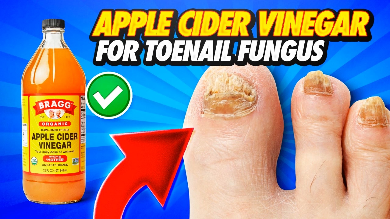 Apple Cider Vinegar for Toenail Fungus What I've learned about using