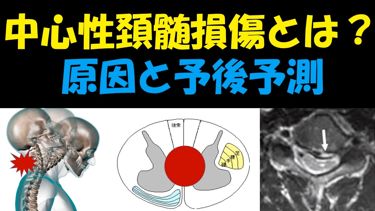 中心性頸髄損傷リハビリガイドライン – 脊髄損傷 ガイドライン 作業療法 – RMHF