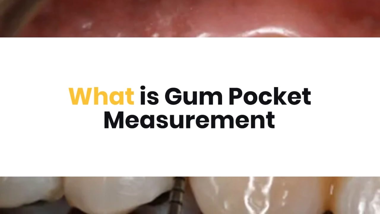 What is Gum Pocket Measurement ニコニコ動画