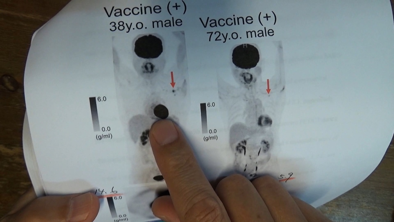 ワクチン後に隠れ心筋炎が半年続くという慶応大学の論文